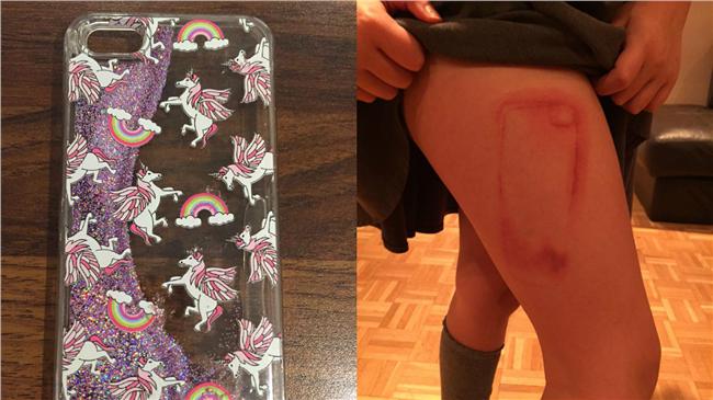 睡破手機殼流毒液　哀鳳痕永留嫩腿！