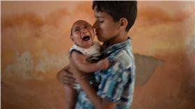 茲卡病毒,小頭症（圖／美聯社／達志影像）