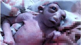 ▲半頭女嬰。（圖／翻攝自《Mirror》）
http://www.mirror.co.uk/news/world-news/miracle-baby-born-half-head-7230861
