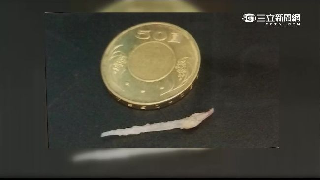 她吞魚刺不理！導致頸動脈破裂死亡