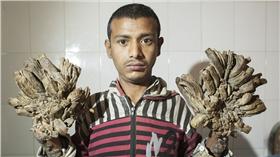 孟加拉男子患有罕見皮膚病，疣狀組織讓他宛如「樹人」
翻攝自每日郵報
http://www.dailymail.co.uk/news/article-3424150/Bangladeshi-man-suffers-rare-condition-causes-tree-like-roots-grow-hands-feet.html