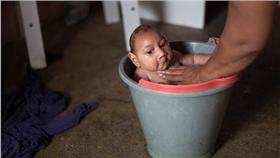 茲卡病毒,小頭症（圖／美聯社／達志影像）