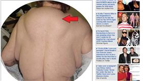 春節,大魚大肉,多發性對稱性脂肪增生症,醫學期刊,囊腫,酗酒,肥胖,脂肪肝,戒酒,抽脂(Daily mail http://www.dailymail.co.uk/health/article-3437050/Woman-drank-heavily-40-years-develops-BOOZE-hump-huge-lumps-neck-arms.html)