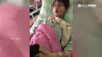 恐怖菜梯重砸　女大生毀容成臉骨拼圖