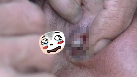 她眼睛「產出」這些東西　醫師嚇到了