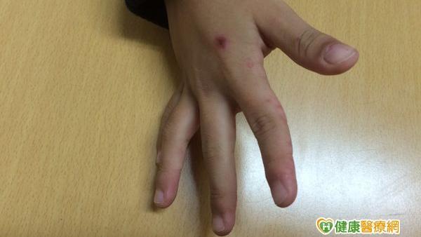 腸胃炎和腸病毒分不清　病症治療皆不