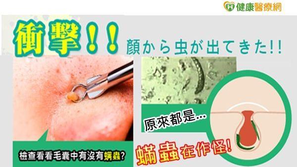 蟲蟲危肌！「蟎」臉痘痘粉刺治不好