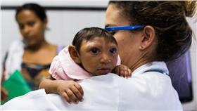 茲卡病毒,小頭症-達志影像