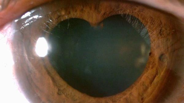 瞳孔變「愛心」了　有這症狀快就醫