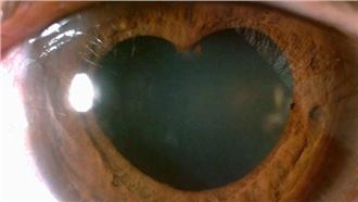 瞳孔變「愛心」了　有這症狀快就醫