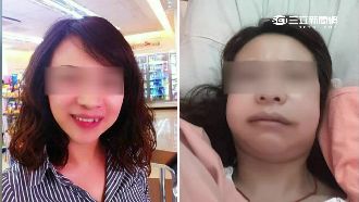 拔智齒痛20天　女控醫拔斷下顎骨