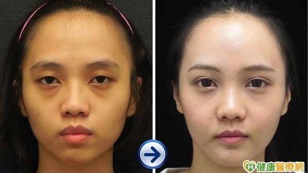 脂肪是冤家？　自體脂肪移植讓您愛上