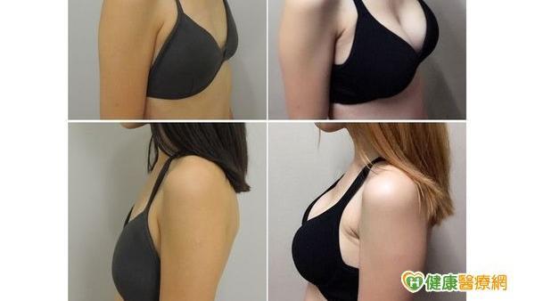 水滴型隆乳　瘦小女也可達成D罩杯夢