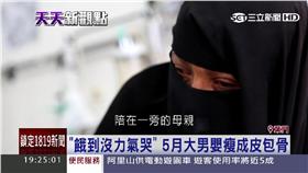 葉門、嬰兒、營養不良