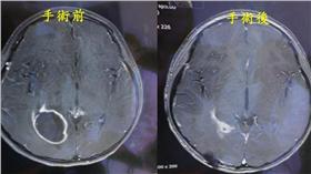 ▲驚！活潑女童個性驟變　原來是腦膿瘍作祟（圖／童綜合醫院）