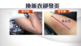 獨／女子穿淘寶網衣竟得蜂窩性組織炎