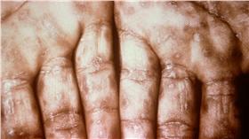 梅毒症狀（圖／翻攝自維基百科）