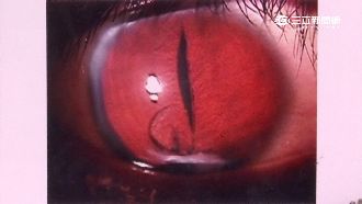 瞳孔變貓眼！男車禍後驚見好多人影