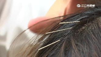 針灸治療後返家　驚見3公分針插胸口