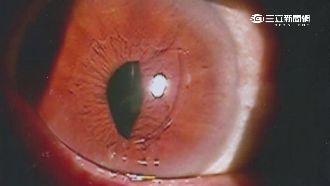 男騎車出車禍　瞳孔撞出「台灣形狀」