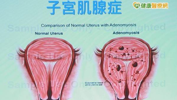 做試管嬰兒還流產？子宮環境不佳導致