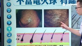 (必)掉髮危機1600