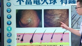 生薑擦頭皮生髮有效？醫師：活絡效果