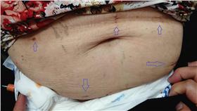 ▲90歲阿嬤來月經？！當心老人婦癌！（圖／亞東醫院）