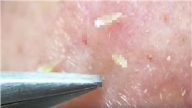 粉刺https://www.youtube.com/watch?v=Kx5AeJcN41I