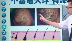 (必)掉髮危機1600