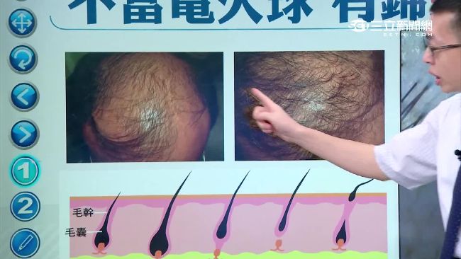 塗生薑防掉髮？醫師：適量能活絡頭皮