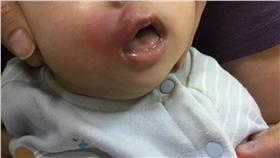 ▲驚！天熱蚊子肆虐　孩子遭咬竟變蜂窩性組織炎（圖／童綜合醫院）