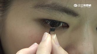搭機隱形眼鏡吸眼球　女硬摘角膜扯下