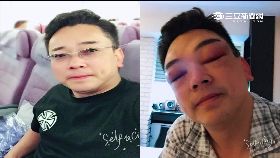 詹惟中眼腫1200.