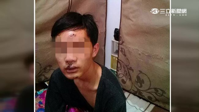 中一中學生摔出公車　臉縫了34針