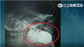 不可能的手術! 哥國大兵