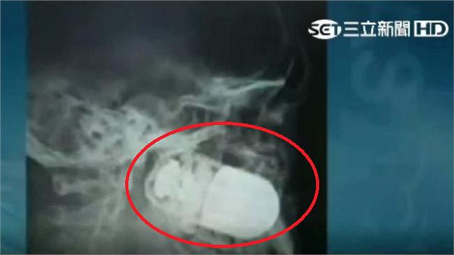 榴彈丟進臉頰　大兵手術奇蹟成功