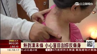 刮痧反傷身？專家教你正確刮痧步驟