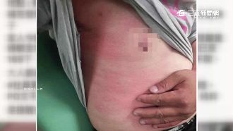 遊客過敏眼腫　桃園傳紅火蟻夜市咬人