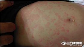 跟爸媽吃泰國餐廳　5歲童急性蕁麻疹