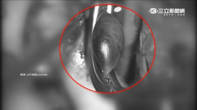 腦血管瘤致命！爆裂1/3恐當場身亡
