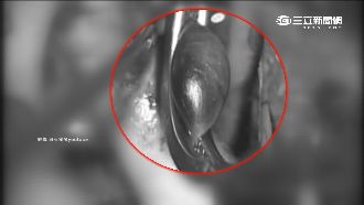 腦血管瘤致命！爆裂1/3恐當場身亡