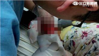 搭電扶梯釀意外　婦人手腕嚴重撕裂傷