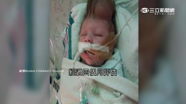 男嬰腦在頭殼外　父母不放棄奇蹟救活