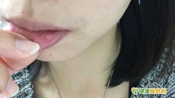嘴破在同一區域逾2週未好　恐是癌變