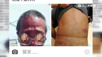 疑被逼簽86萬本票　老伯慘遭痛毆
