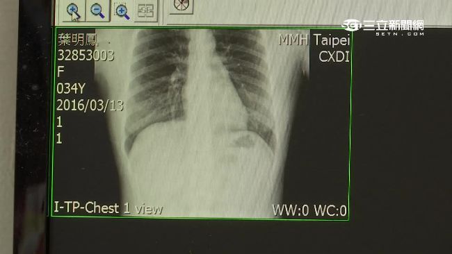 名醫誤診？甲狀腺瘤惡性比率不到5%