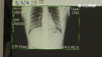 名醫誤診？甲狀腺瘤惡性比率不到5%