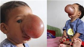 孟加拉、女童、腫瘤（合成圖／圖翻攝自每日郵報）