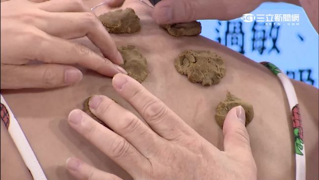 慢性虛寒及過敏　中醫用這招減輕症狀